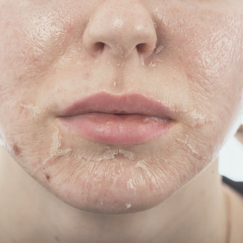 Peeling químico avanzado para renovar la piel y mejorar su textura, realizado por la Dra. Lola Lopera en Cádiz.