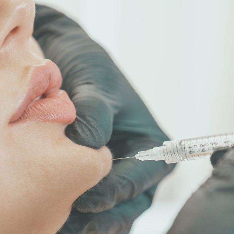 Relleno de mentón para armonizar el perfil facial, realizado por la Dra. Lola Lopera en Cádiz.