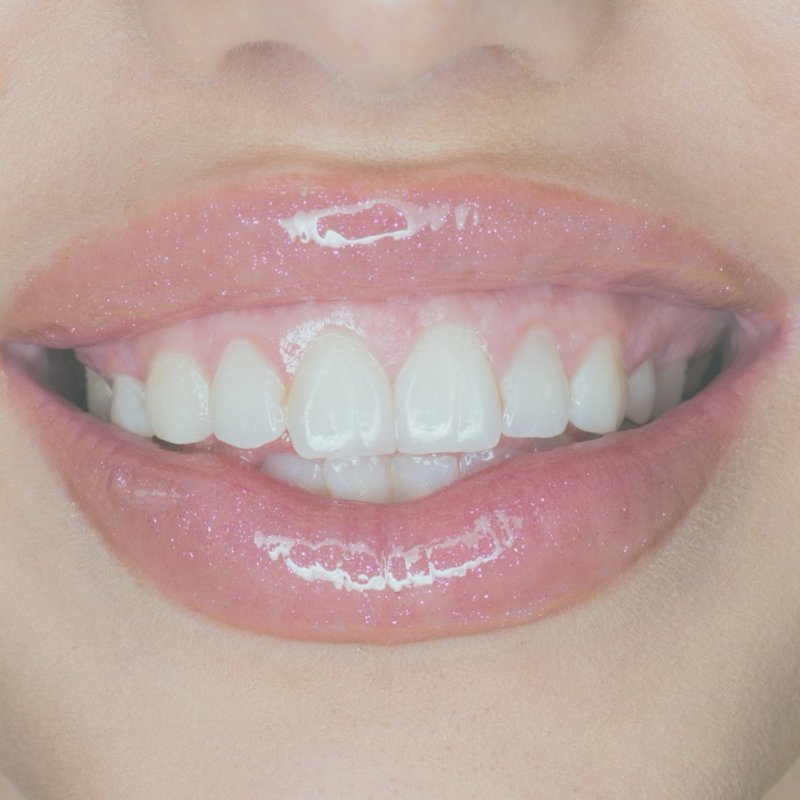 Tratamiento para sonrisa gingival con técnicas avanzadas, realizado por la Dra. Lola Lopera en Cádiz.
